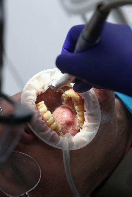 Bělení zubů cena: Jak ušetřit za bílý úsměv?