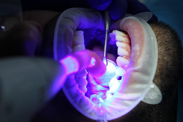 Vedlejší účinky vnitřního bělení zubů