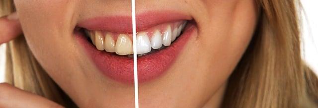Jak si udržet zuby bílé po návštěvě dentální hygieničky?